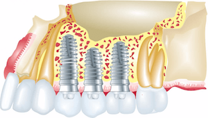dentalimplantarlingotn