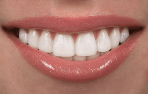 DRKHAN_DentalVeneers