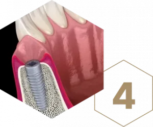 Single Tooth Dental Implants