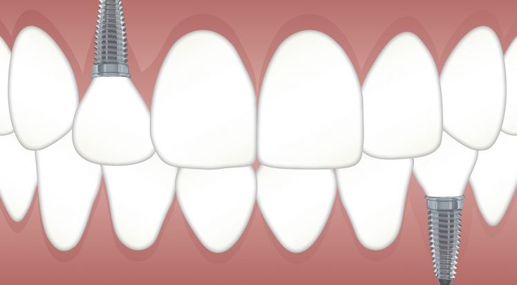 teeth, implant, orthodontics